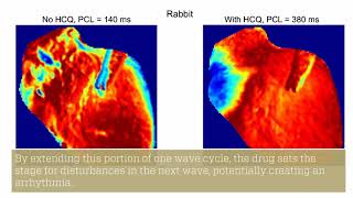 Study Shows Hydroxychloroquine’s Harmful Effects on Heart Rhythm