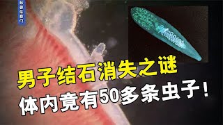 结石消失之谜，男子体内竟有50多条虫子！原因竟与生鱼片有关【科普任意门】