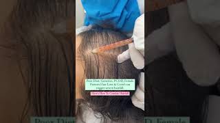 PRP - Best hair loss treatment for females #shorts