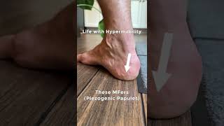 Life with hypermobility and Ehlers Danlos related symptoms #flexibility