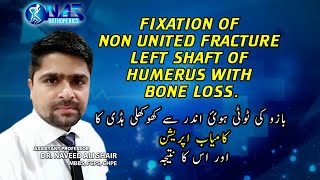 Success story after fixation of non United fracture left shaft of humerus with bone loss.