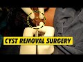 Cyst removal Surgery @dezireclinic