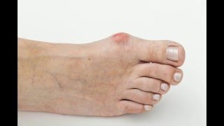 Advanced Foot \u0026 Ankle Care Specialists | Bunions | (214) 366-4600