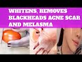 EFFECTIVE TO WHITENS & REMOVES BLACKHEADS | Ganda't Kalusugan Tips