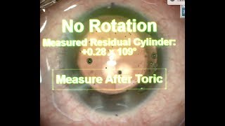 Premium cataract surgery: FLAC(Z8) + ORA(Alcon) + MF15T(Oculentis): My first Toric case by ORA