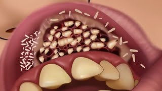 Brain ASMR Remove Maggot Infection Dental Care Treatment Animation
