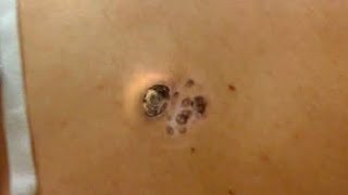 Blackheads \u0026 Milia, Big Cystic Acne Blackheads Extraction Whiteheads Removal Bad skin.