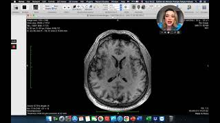 Como achar o Sulco Central? Neuroanatomia Seccional