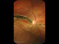 CHRONIC INFERIOR RETINAL DETACHMENT, MACULA OFF, HIGH WATER MARKS