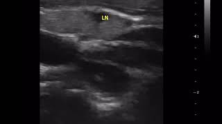 CASE 236  METASTATIC CERVICAL LYMPHADENOPATHY US