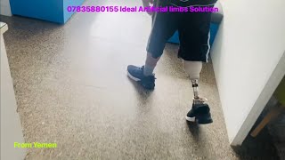 07835880155 came from Yemen | fitment of Artificial leg just after 3rd week of amputation