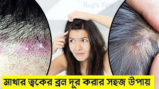 মাথায় ব্রণ হলে আপনার যা করণীয় - How to get rid of PIMPLES - মাথায় pimples কেন হয়?