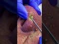 squeezing old blackheads on nose