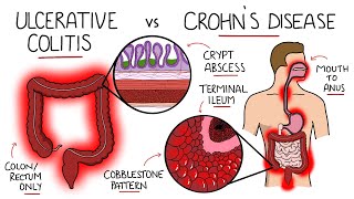 Inflammatory Bowel Disease - Ulcerative Colitis v Crohn's Disease (With Histology & Manifestations)