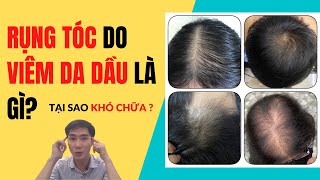 Rụng Tóc Do Viêm Da Dầu Là Gì ? Tại Sao Khó Chữa ? #1
