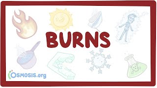 Burns - an Osmosis Preview