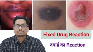 दवाई का Reaction | Fixed Drug Reaction | Paracetamol, Ciprofloxacin, Metronidazole, Ornidazole, PCM