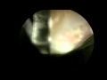 Posterior Elbow Release Surgery for Stiffness by Houston Orthopedic Surgeon Dr Jeffrey E Budoff