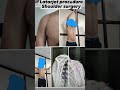 Latarjet procedure for recurrent dislocation of shoulder. Very good result.