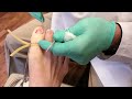 permanent toenail removal in less than 4 minutes