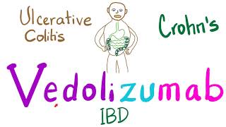 Management of Inflammatory Bowel Disease (IBD): Crohn's and Ulcerative Colitis