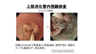 免疫栄養ケトン食療法　学会発表シリーズ：食道がん症例