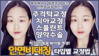 안면비대칭! 유형만 알면 수술없이 교정 가능합니다!｜정파카