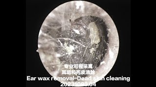 （去色版）专业可视采耳-耳垢和死皮清除Ear wax removal-Dead skin cleaning 20231003.04