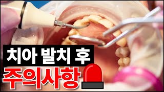 '치아 발치 후' 주의사항 이것만 보세요 ｜붓기, 멍, 지혈, 빨리 아무는 방법 꿀팁