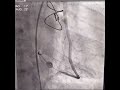 Angiogram of Sequential Bypass graft