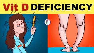 Vitamin D Deficiency | Vitamin D Deficiency Symptoms | Vitamin D Deficiency Rickets | Osteomalacia