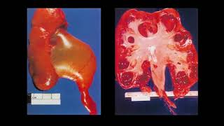 17 Renal \u0026 Urinary Tract D/O a04