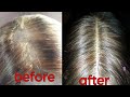 How To Refill A Bald closure or frontal