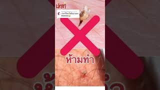 โดน”ผึ้งต่อย” ❌ห้ามทำแบบนี้🐝 #ผึ้งต่อย#เล่ายา