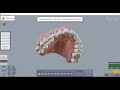 archform canine rotation with buccal lingual attachments