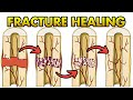 Bone Healing Process Explained in Details