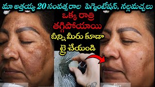 🔥మా అత్తయ్య 20 సంవత్సరాల పెగ్మెంటేషన్, నల్ల మచ్చలు ఒక్క రాత్రి తగ్గిపోయాయి|Get Rid of Pigmentation 👍