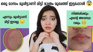 ഒരു മാസം മുൾട്ടാണി മിട്ടി മാത്രം മുഖത്ത് ഇട്ട എന്റെ അനുഭവം | Apply multtani mitti for 1 month