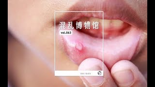 你為什麼口腔潰瘍 |Why are you suffering from oral ulcers | ChaosMuseum