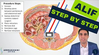 Anterior lumbar interbody fusion (ALIF) - Step by step procedure details, anatomy, & recovery review