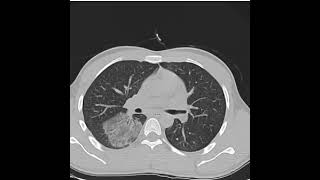 lung findings in CT scan #radiology☢️#👀👍🔔🙏