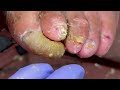 immersive pedicure experience extra long yellow onychomycosis 【doctor liu pedicure】