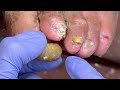 immersive pedicure experience extra long yellow onychomycosis 【doctor liu pedicure】