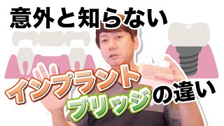 【歯がなくなった時の選択】知らないと困る！インプラントとブリッジ結局どっちがオススメ？