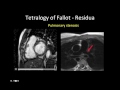 challenges imaging adults with congenital heart disease