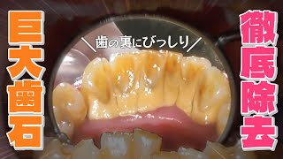 【巨大歯石除去】〇〇が気になってご来院！