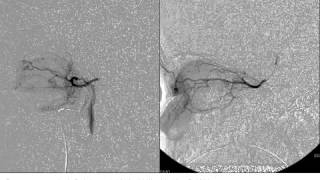 Success of Intra-arterial Chemotherapy (Chemosurgery) for Retinoblastoma: Effect of Orbitovascular A