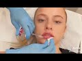 lip fillers with dr kerri in edinburgh