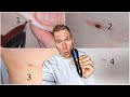 VOONEEN Mole Removal Pen | Leberflecke selbst entfernen? 🤔 (TEST)