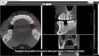 OrisWin software tutorial - How to use MPR - multiplanar reconstruction in 3D